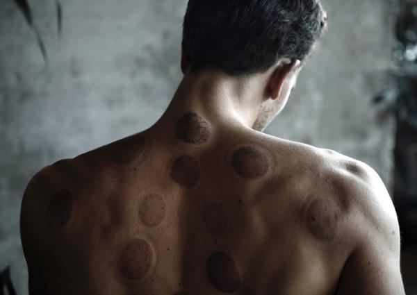 The range of wellness services is extensive and includes cupping / photo: Remedy Place 